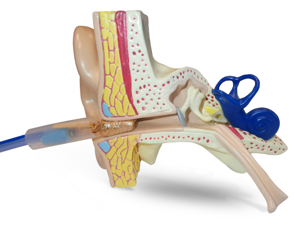 ECochG-Paket (extratympanal)
